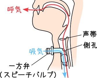 気管切開でも声が戻る？スピーチカニューレの真実と現場の注意点