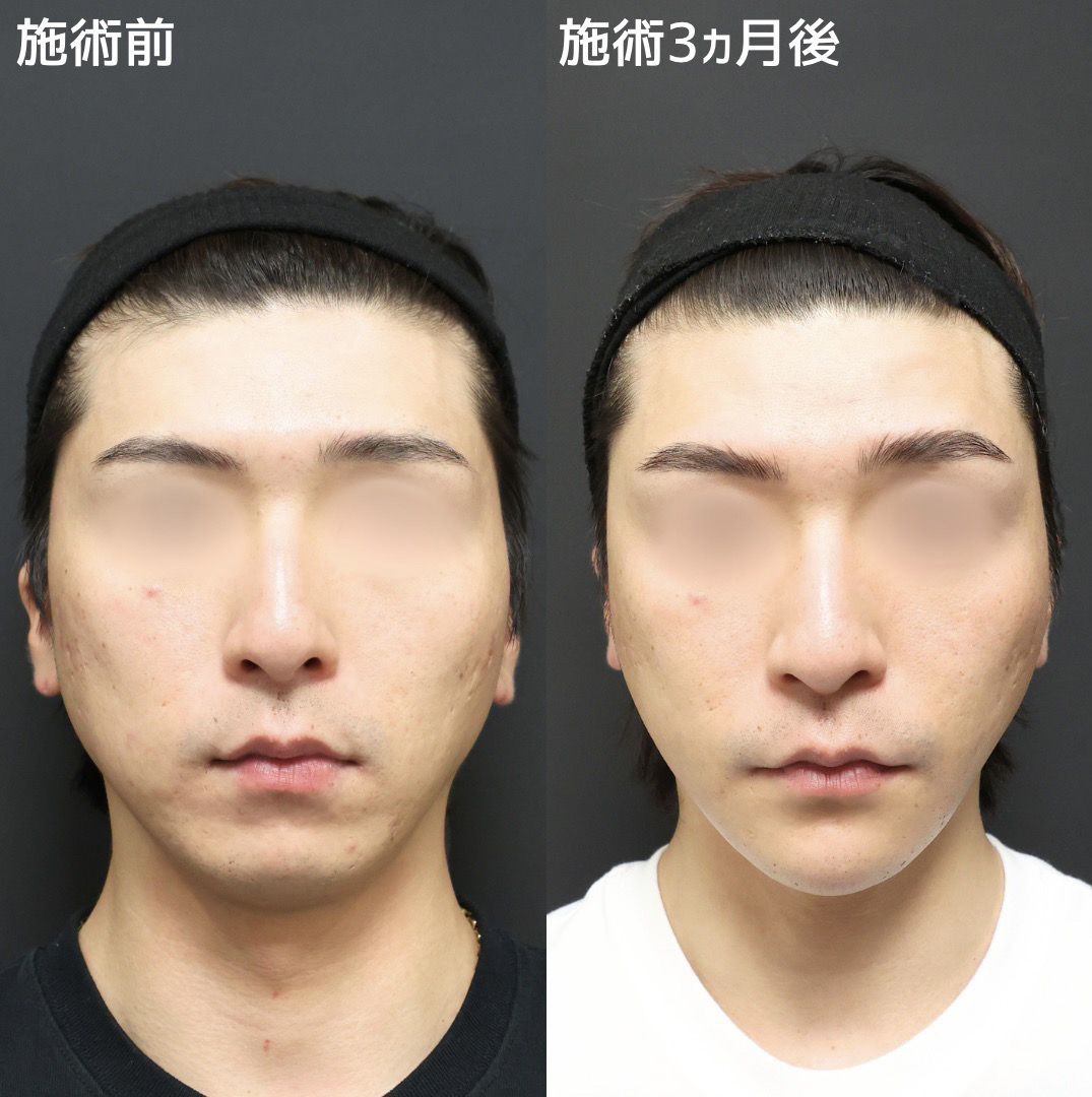 なぜ男性の顔痩せは失敗する？二重あごとたるみを最速で落とす新常識