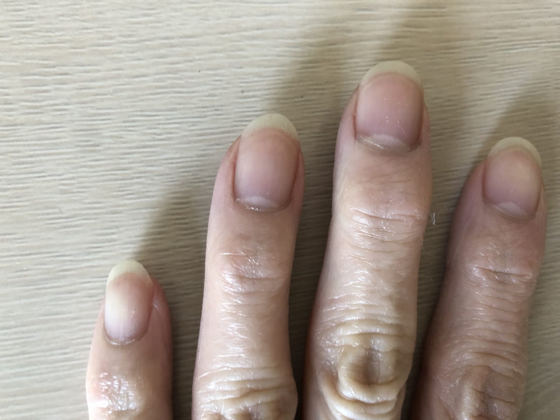 コロナで爪の色が紫や赤に？話題の症状と危険なサイン・受診の目安