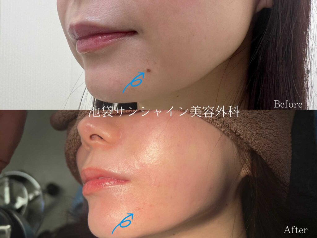 ほくろの毛はなぜ太い？絶対に抜いてはいけない危険な理由と正しい処理法