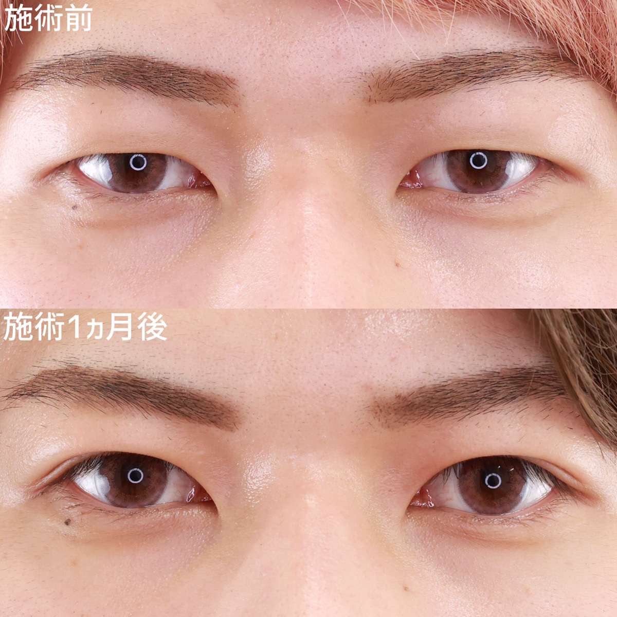 二重イケメンが惹きつける真の理由｜平行・末広の魅力と最新目元トレンド