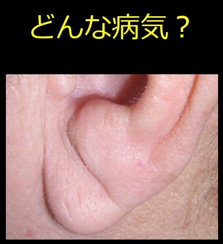 【真相】 動脈 硬化 耳たぶ 画像 最新情報まとめ 2026 #776