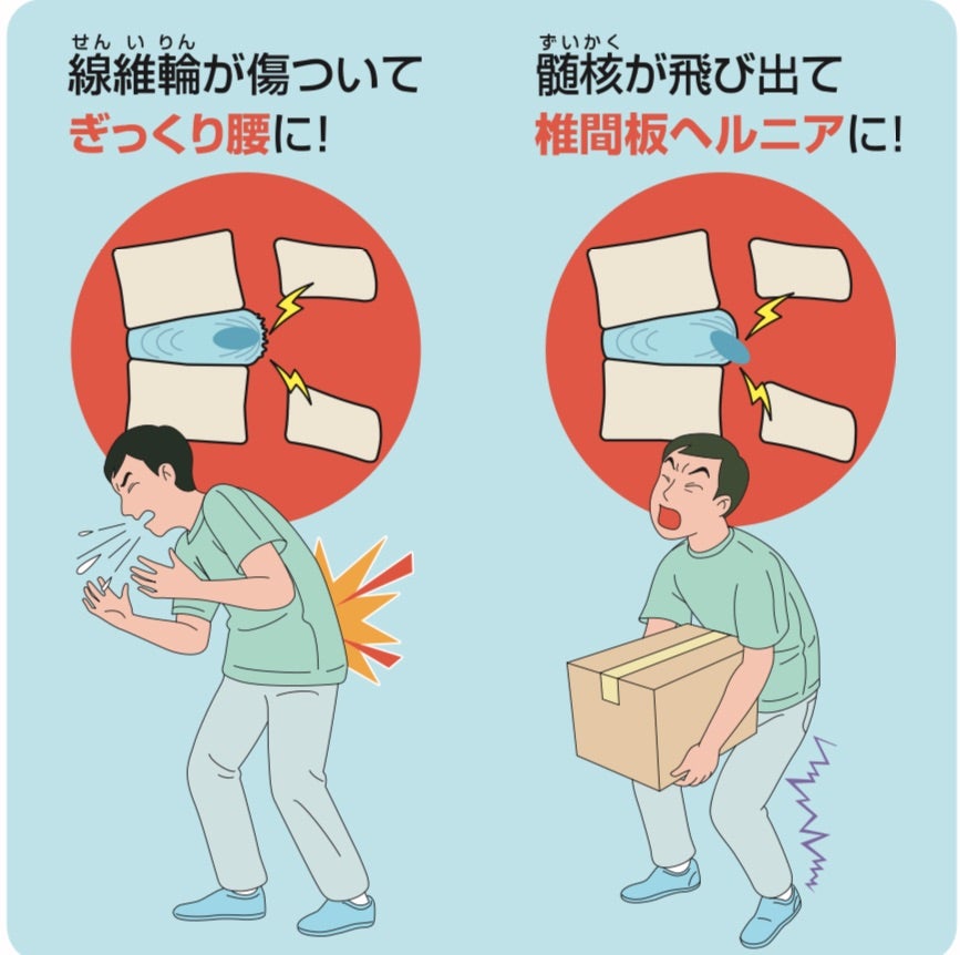 ただの腰痛が実は癌だった？闘病ブログが語る見落としのサインと真実