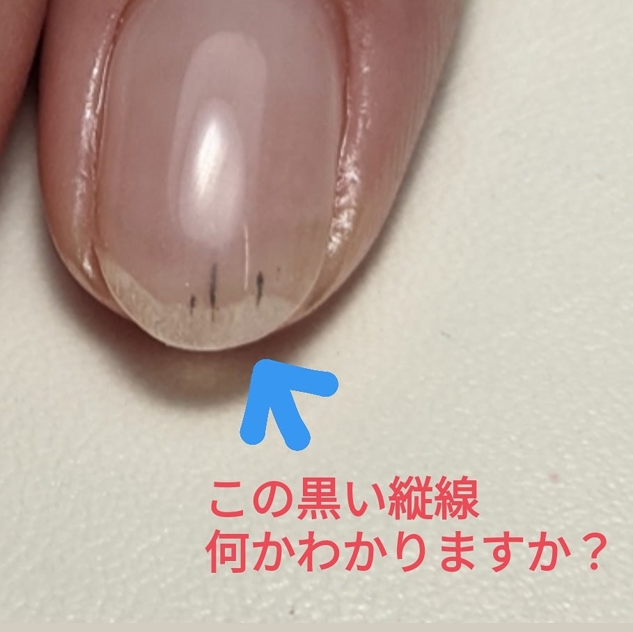 爪の中の黒い線は放置Ng？メラノーマの見分け方と危険な兆候【2026】