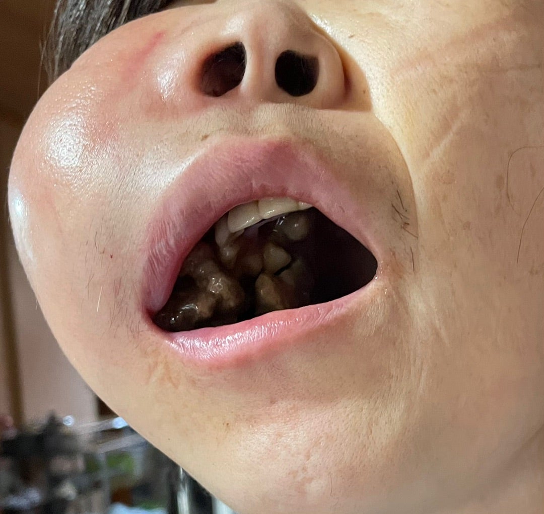 皮膚から癌が飛び出す画像の真相｜自潰創の病態と初期サインを解説