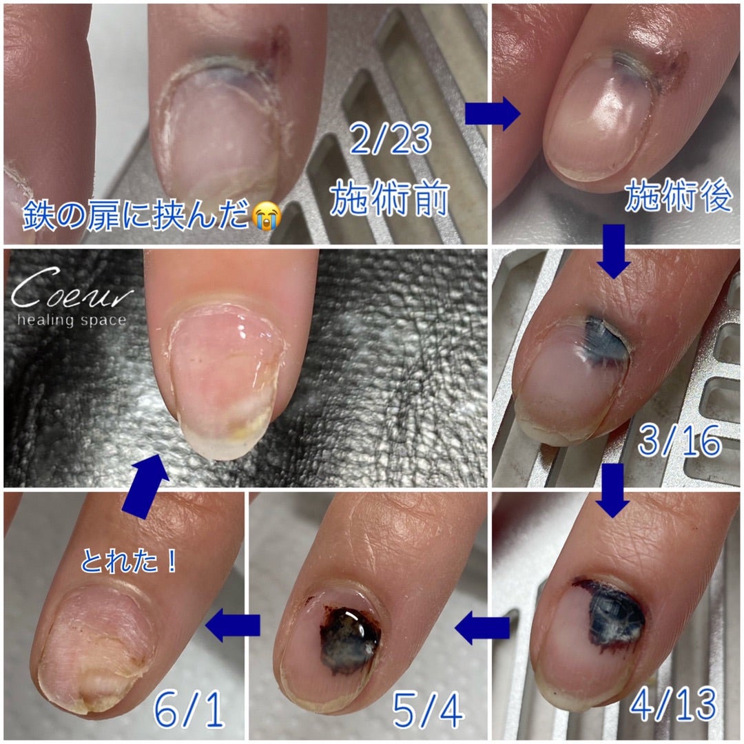 指を挟んだ内出血は放置Ng？激痛や爪の変色と骨折の見分け方