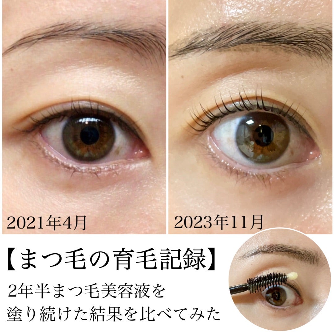まつげ美容液の色素沈着は治る？目の周りの黒ずみ原因と対策