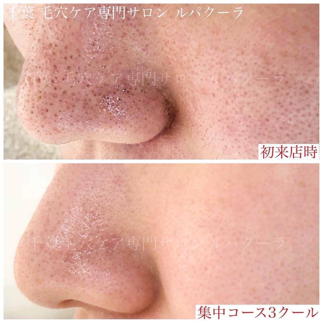 鼻の脂が拭いてもすぐ出る原因とは？ギトギト毛穴を根本改善する新常識