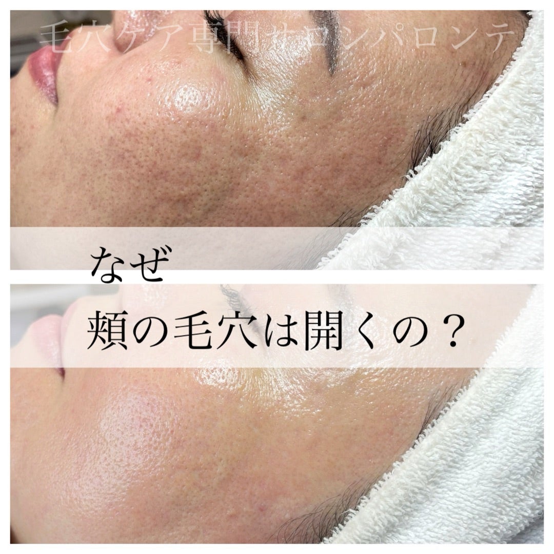 なぜ頬の毛穴が目立つ？たるみ肌を毛穴レスへ導く最新改善法を徹底解説