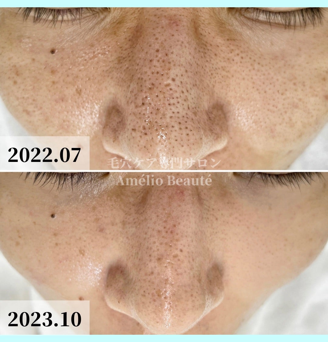 なぜ毛穴の開きは治らない？良かれと思ったNgケアと2026最新医療