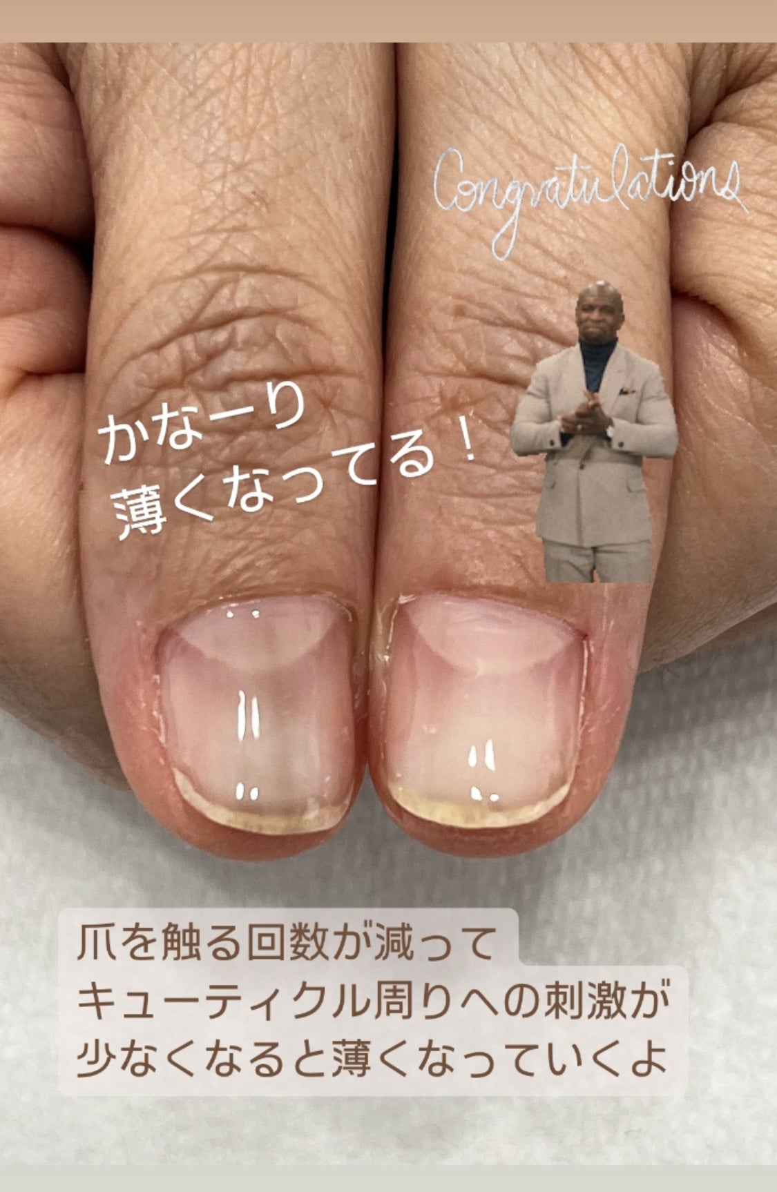 爪の茶色い線は放置Ng？メラノーマとほくろの見分け方を徹底解説