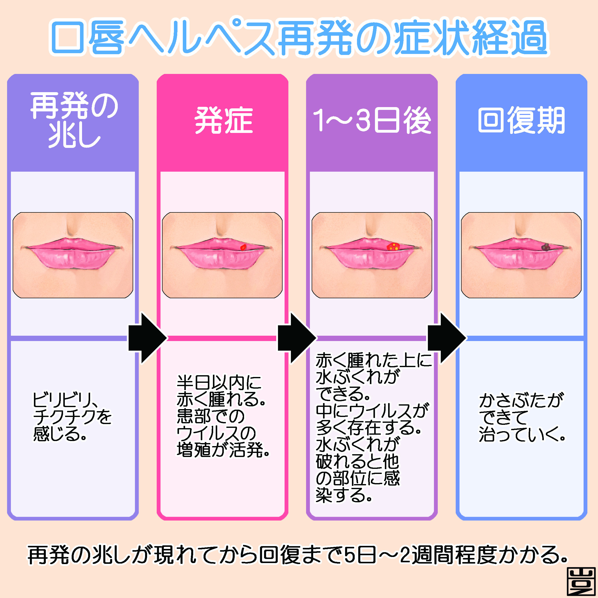 口唇ヘルペス初期の治し方｜水ぶくれ前のピリピリ対処と市販薬選び