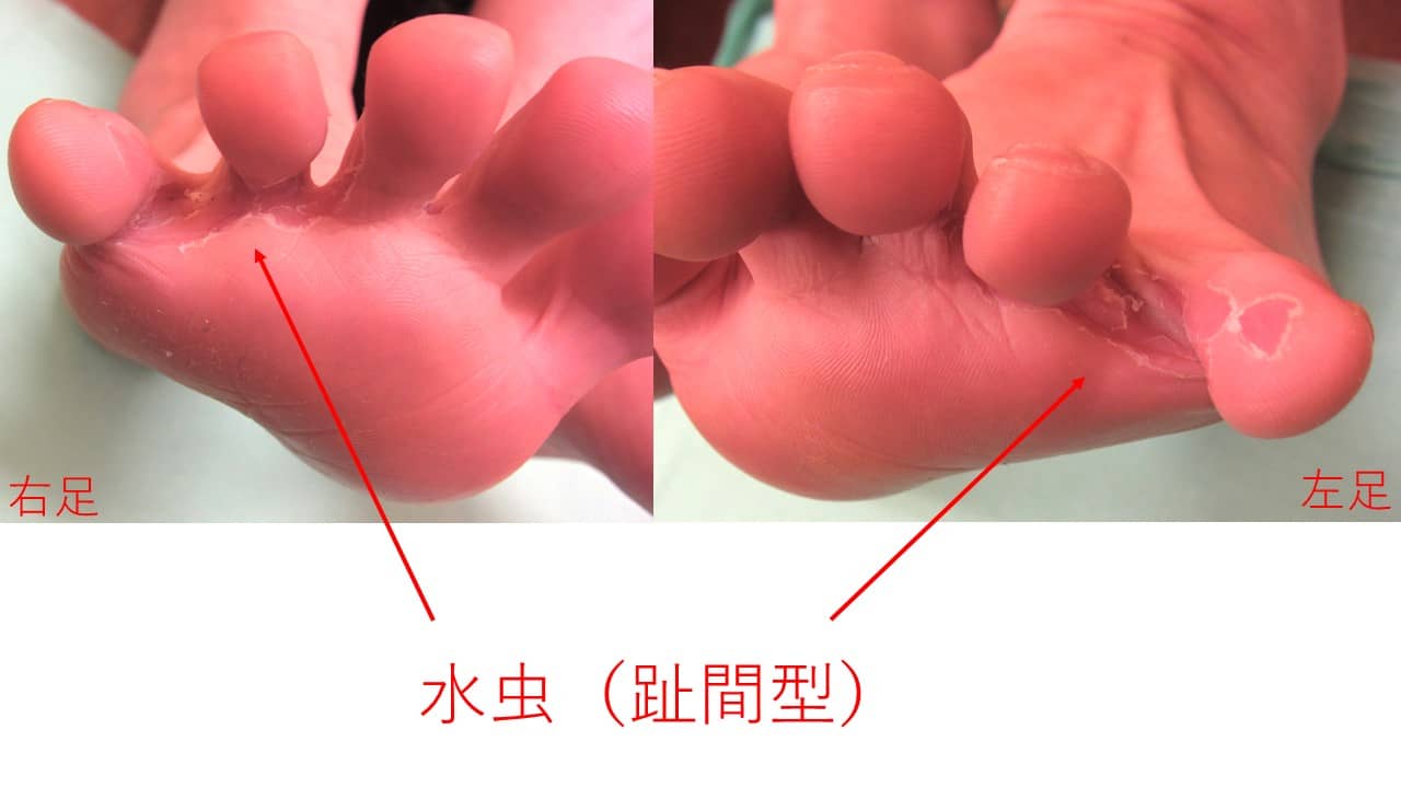 足の指の間の皮がむける原因は？かゆくない水虫の真実と最新対策