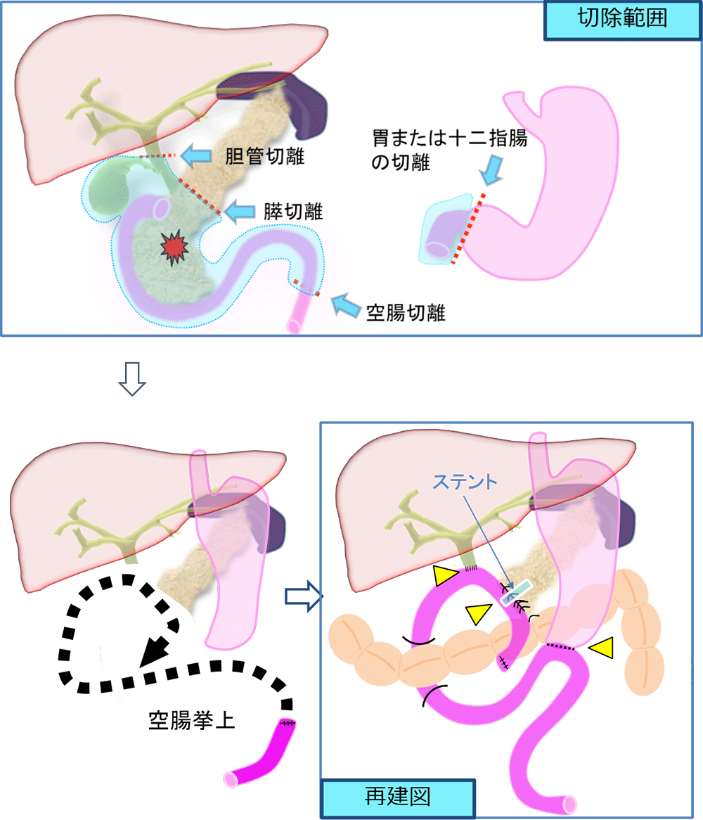 膵頭十二指腸切除術の真実｜手術時間・合併症から生存率と後遺症まで