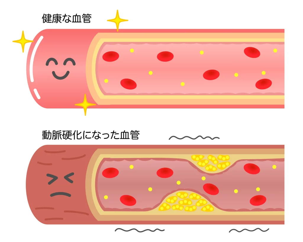 動いた時の胸痛は心筋梗塞のサイン？労作性狭心症の初期症状と2026年最新治療