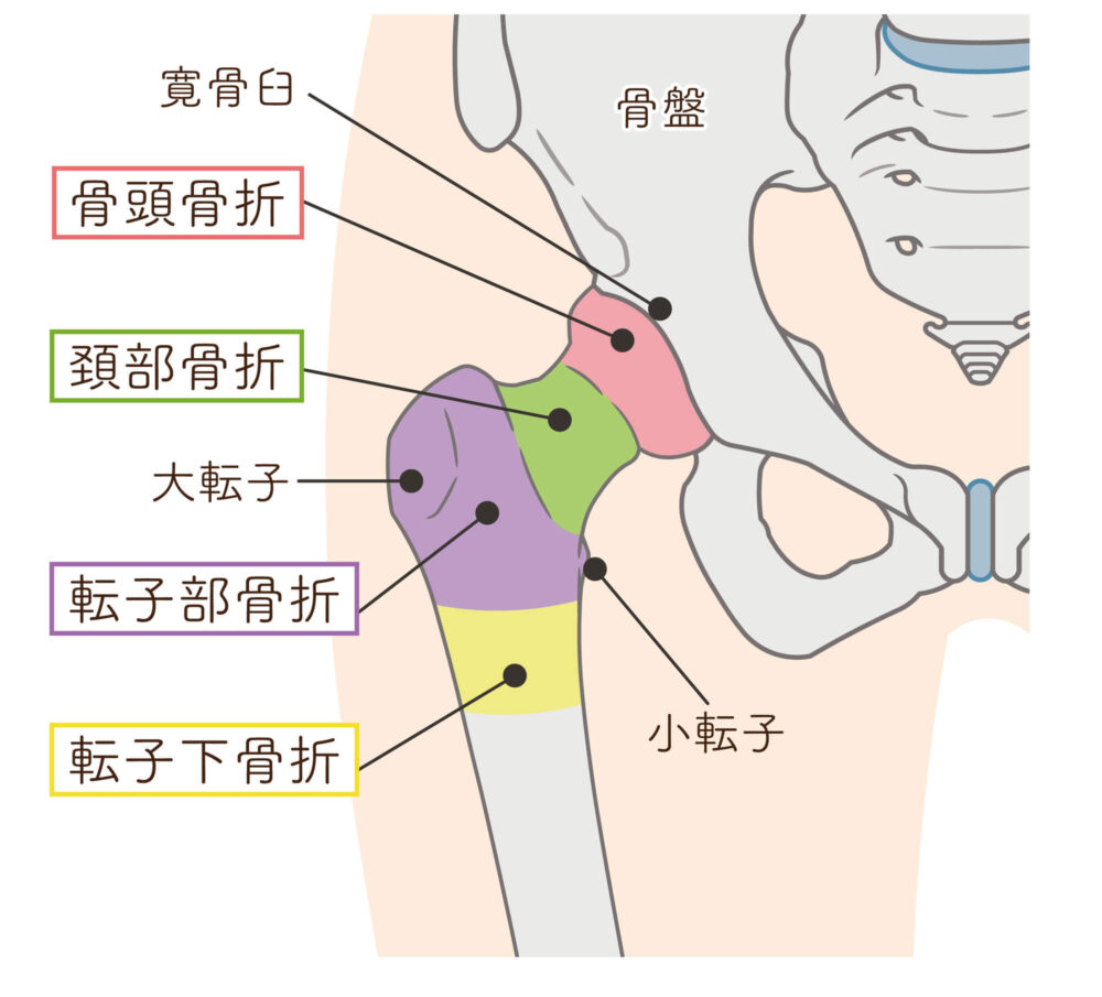 大腿骨頸部骨折で寝たきりを防ぐ！手術とリハビリ予後の真実
