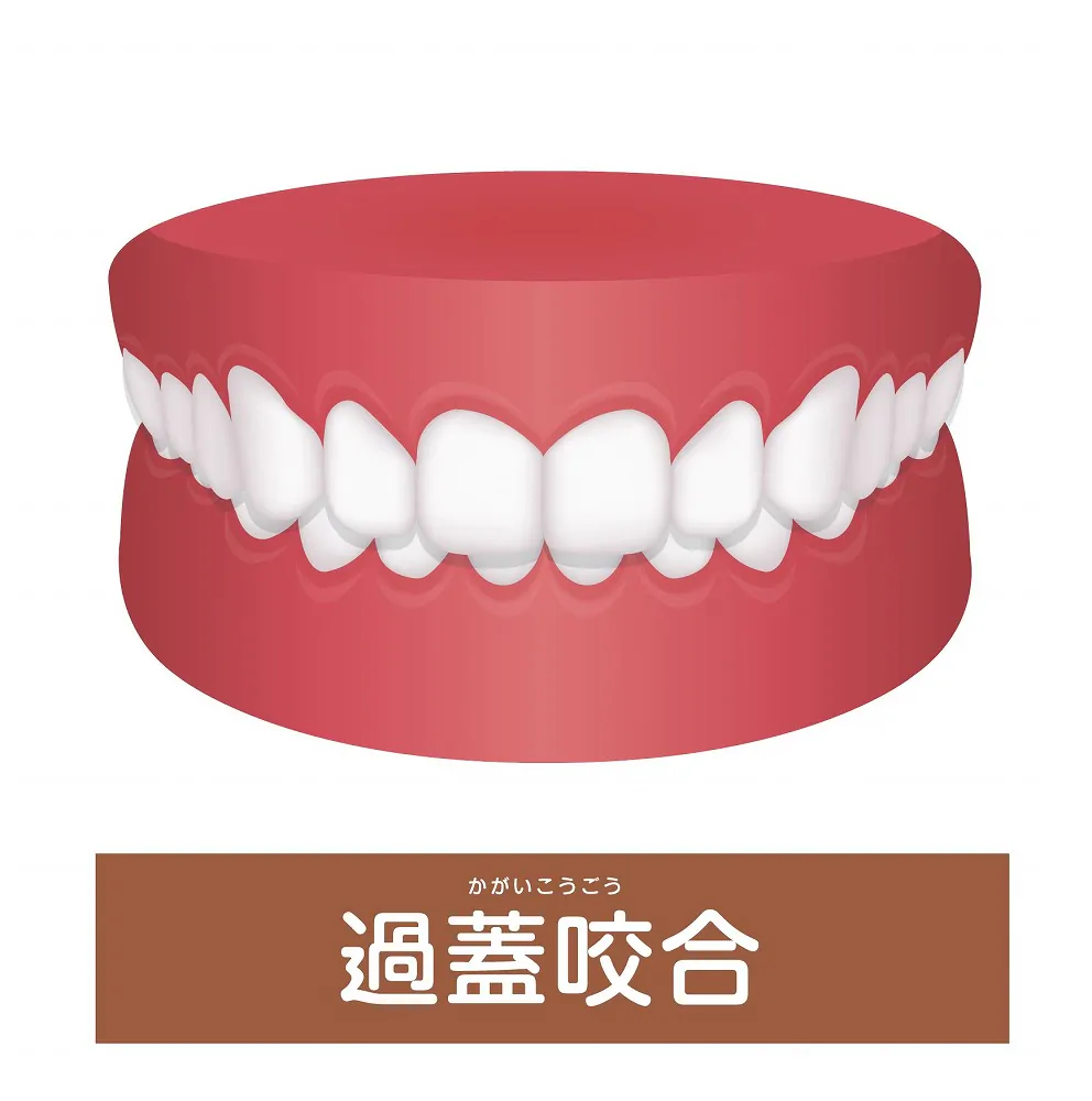 噛み合わせが深い「過蓋咬合」の真実｜放置リスクと最新治療法・費用