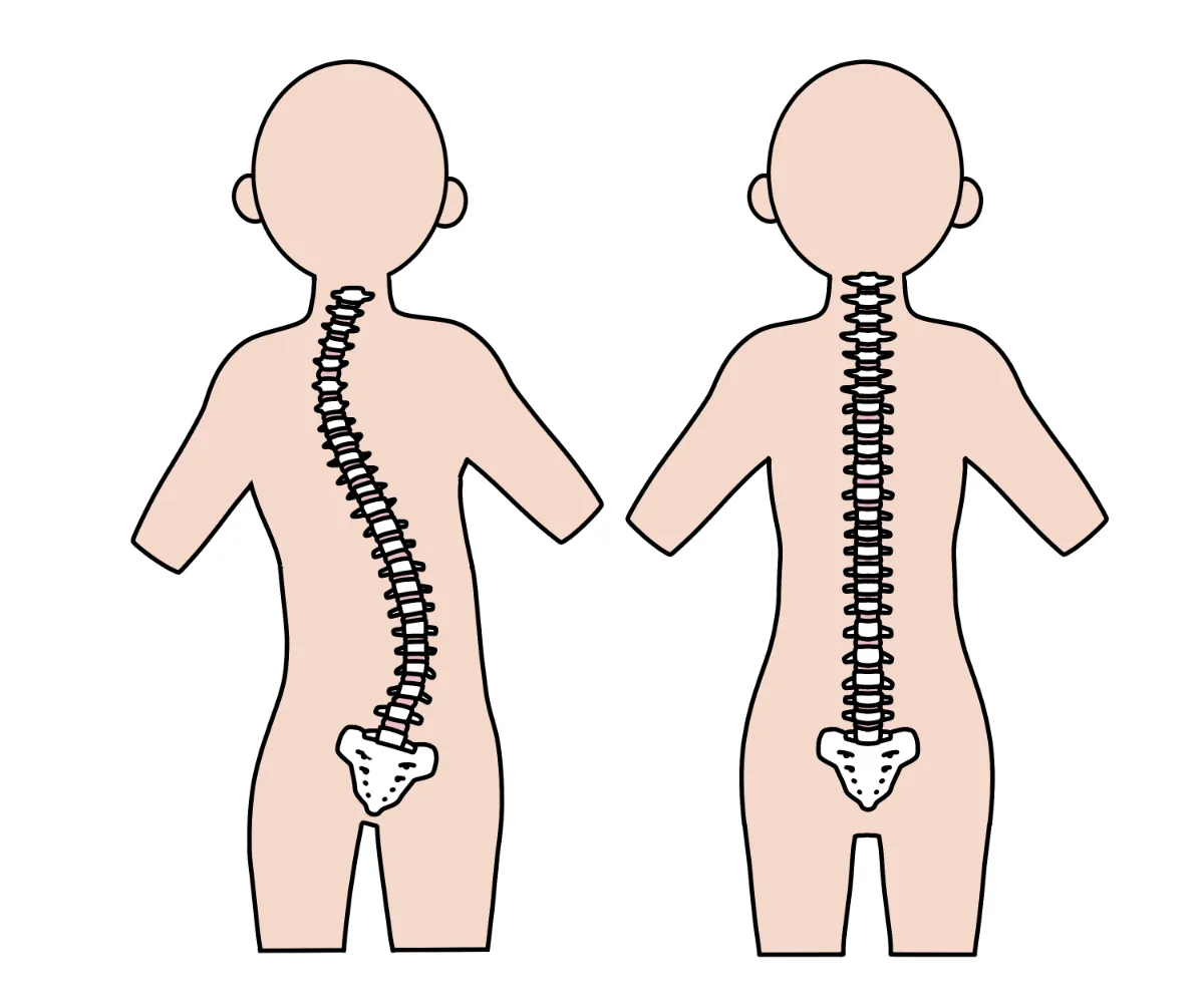 側弯症でやってはいけないこととは？歪みを悪化させるNg習慣と最新基準