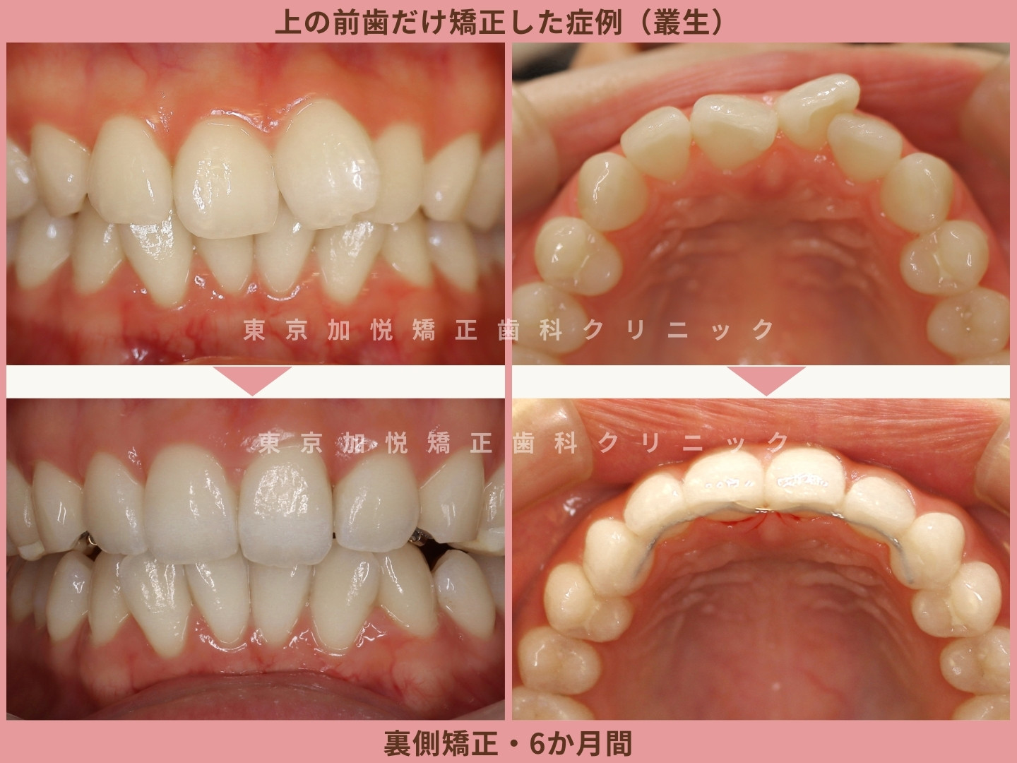 前歯だけ矯正で後悔する人の共通点と失敗しない条件を徹底解説