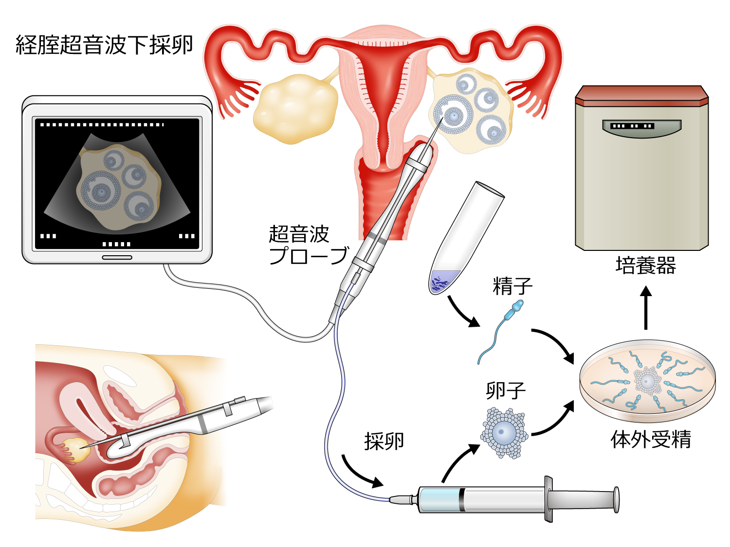 体外受精とは？人工授精との違いや費用・成功率・保険適用を徹底解説