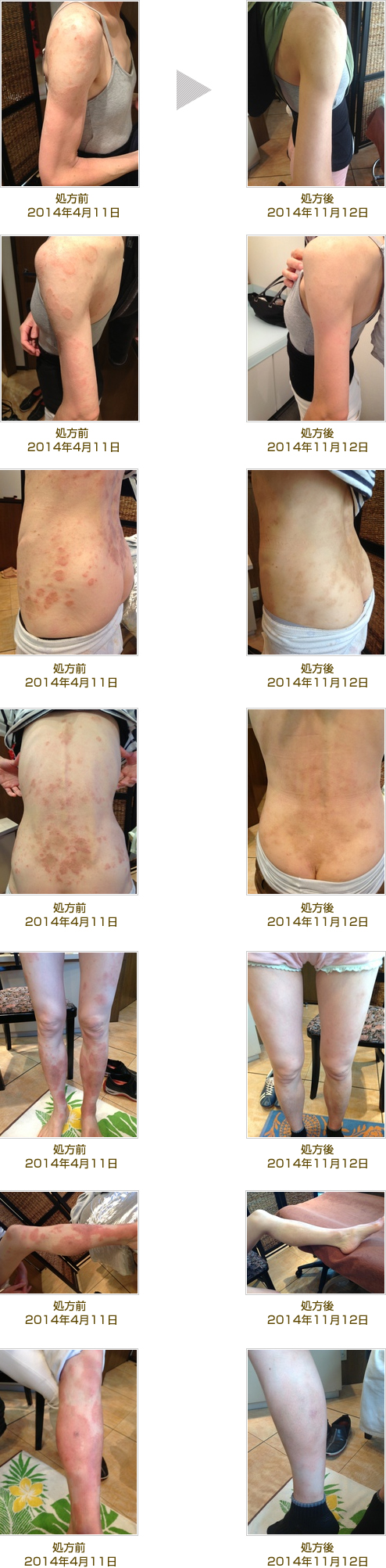 汗の激痛チクチク…コリン性蕁麻疹の原因と2026年最新の治し方解説