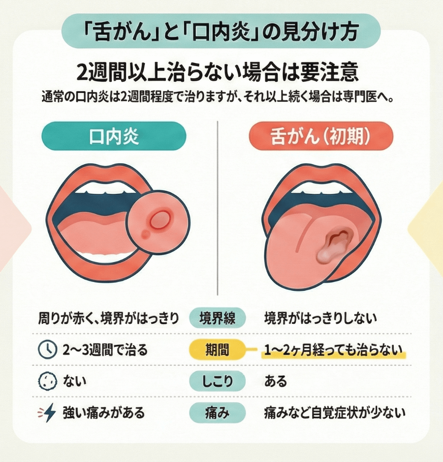 舌癌と口内炎の決定的な違いとは？2週間治らない危険サインと見分け方