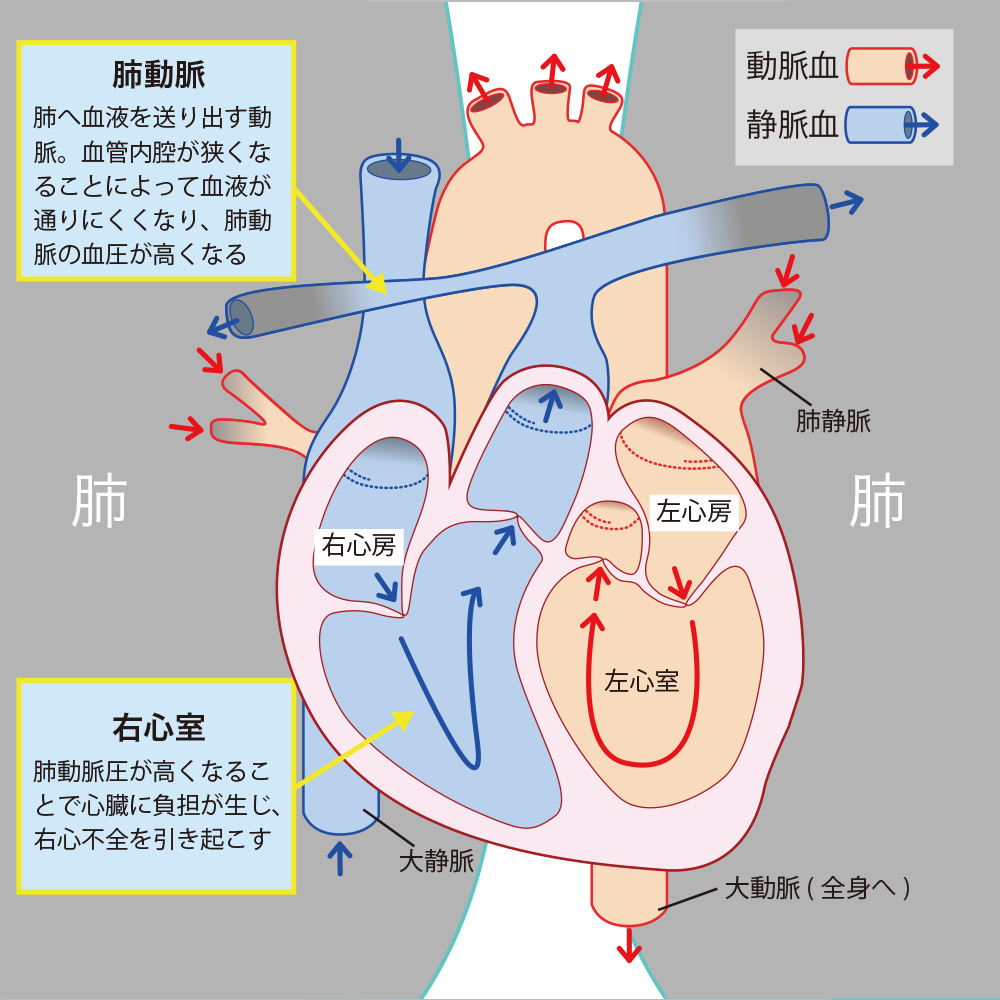 気管支拡張症の真実｜治るのか？余命の誤解と2026年最新治療